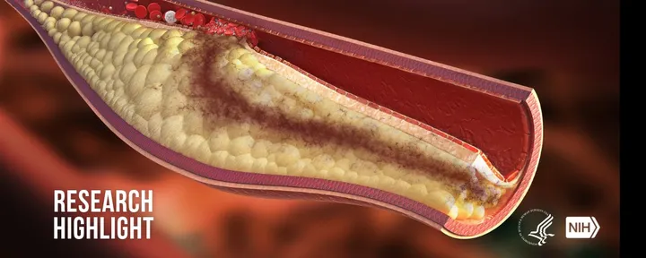 文章封面:NIH researchers uncover potential therapeutic target for atherosclerotic disease